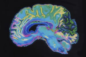 Changes in Brain Thickness, Size Help Explain Sex Addiction in Parkinson’s Patients