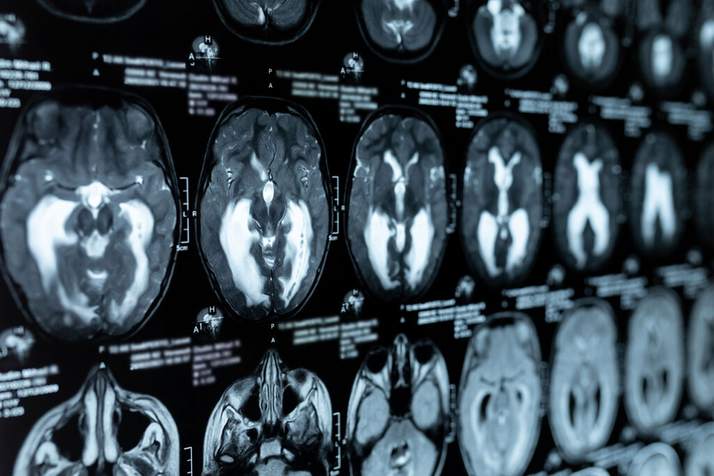 ct scan images to help clinician explain to patient what are the symptoms of wet brain